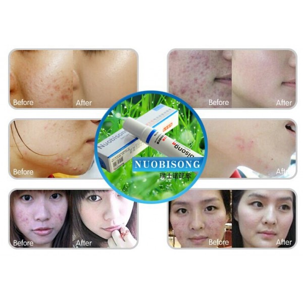 fast acne scar removal cream