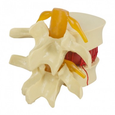Medical Spine Lumbar Disc Herniation Model Lumbar Vertebrae Degenerative Lumbar Disc Herniation Demonstration Model Human Spine